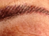 87 year old woman with new Brow