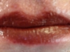 Lip after Indian Earth old after first implant of lip color and picking up the vermilion line.