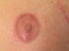 Areola healed after 8 months.