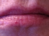 Lip Before older women with wrinkles and loss of the vermilion.